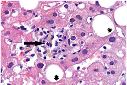 Liver parenchyma with Intralobular necro-inflammatory focus (arrow) and focal lesions of steatosis (stars).