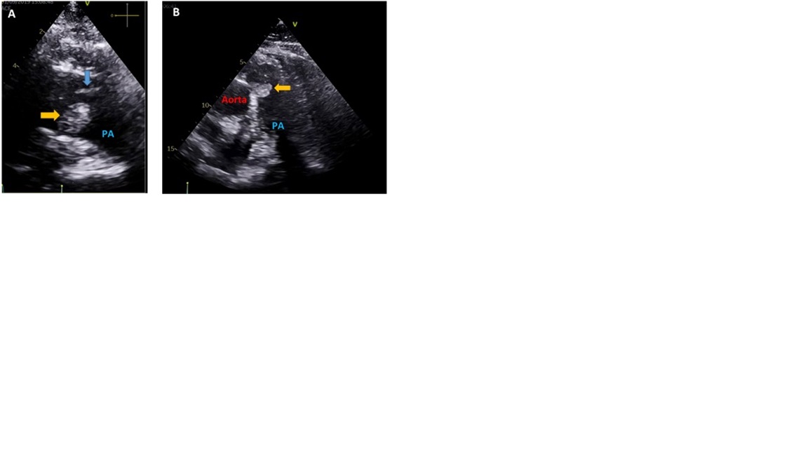 Transthoracic echocardiogram - parasternal short-axis view of the great vessels (A) and subcostal short-axis view (B) – show a rounded well delimitated homogenous mass (24x12 mm) (yellow arrow) apparently adherent to the medial wall of the main pulmonary artery, immediately distal to the pulmonary valve (blue arrow), mobile and non-obstructive 