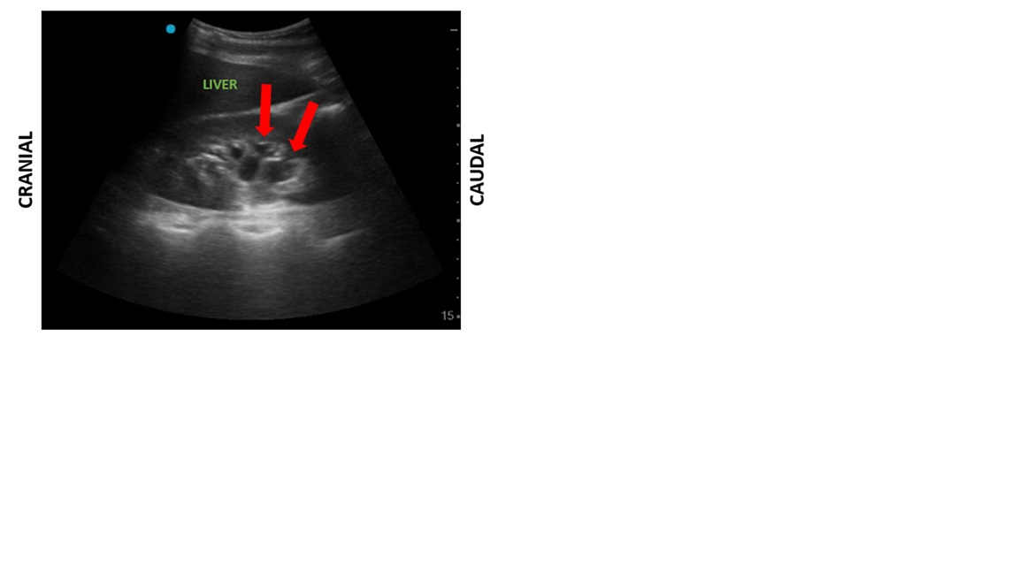 Longitudinal view of the right kidney showing mild  hydronephrosis (red arrows). The blue circle signals the transducer marker in the cranial direction.